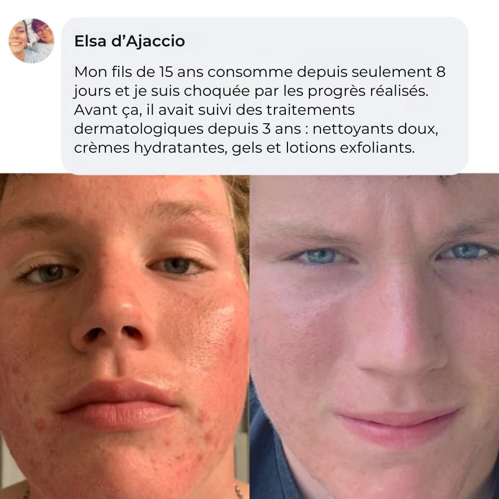 Complete Anti-Acne Ritual - The #1 Natural Solution in France