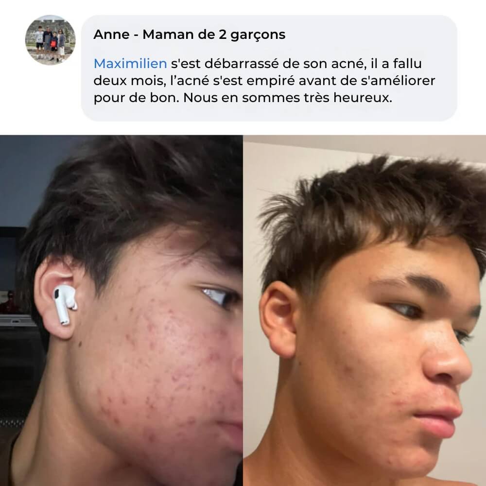 Complete Anti-Acne Ritual - The #1 Natural Solution in France